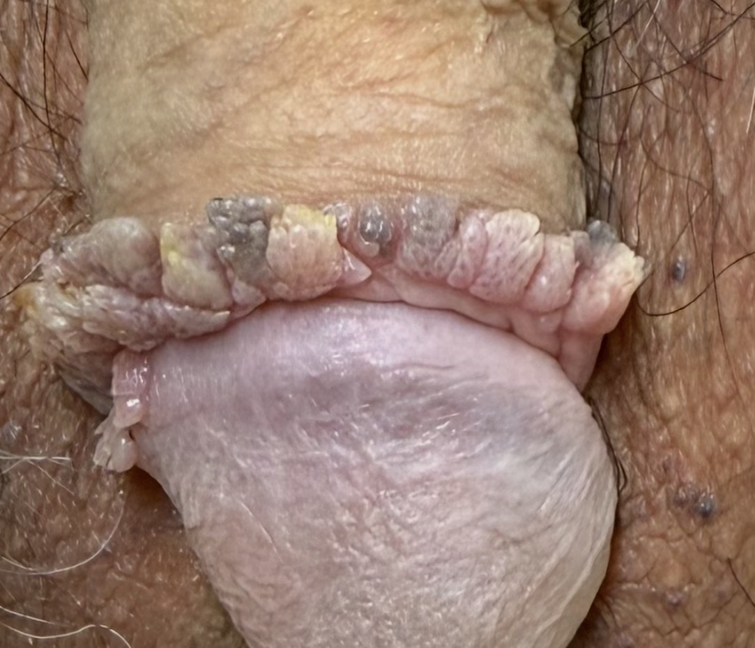 尖形コンジローマの当院症例写真